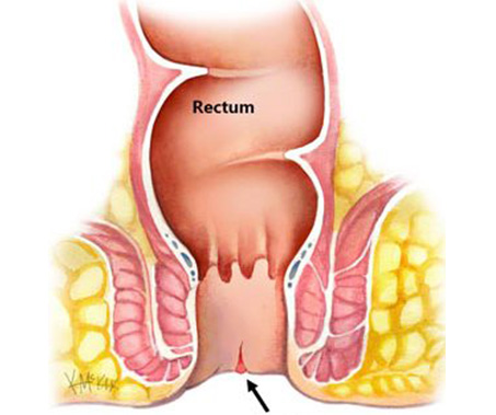 Anal fissure diagram